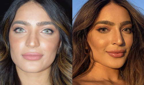 Lip Filler Symmetry Correction Before After Oakville Lip Doctor